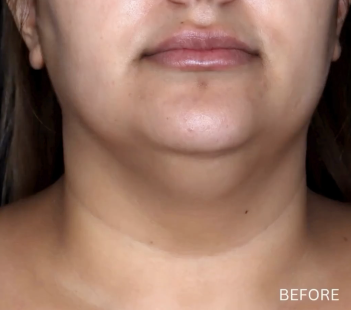 Before photo of a jawline treatment