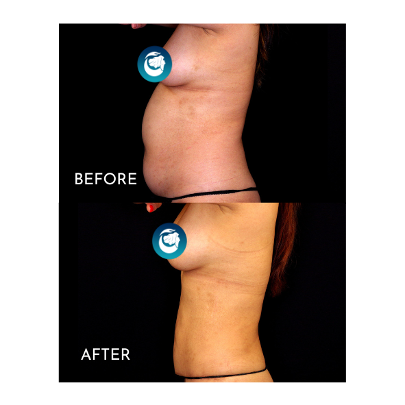 mini tummy tuck before and after